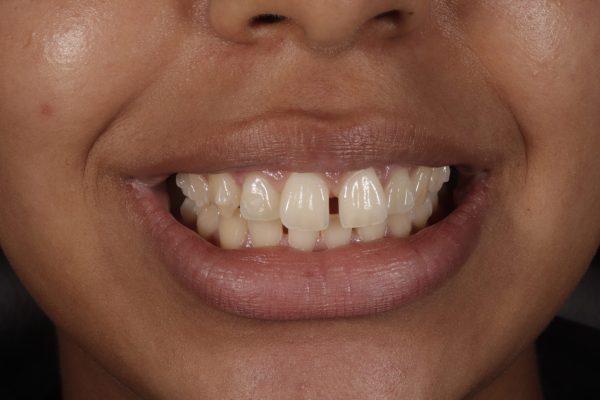 Invisalign in Hither Green before and after