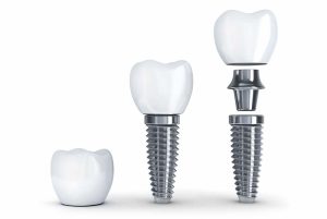 dental implants