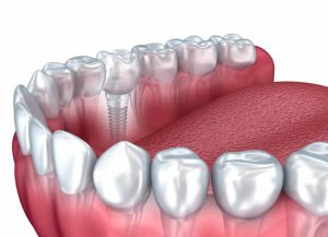 single implant Dental Implants