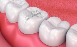 dental fillings in eltham